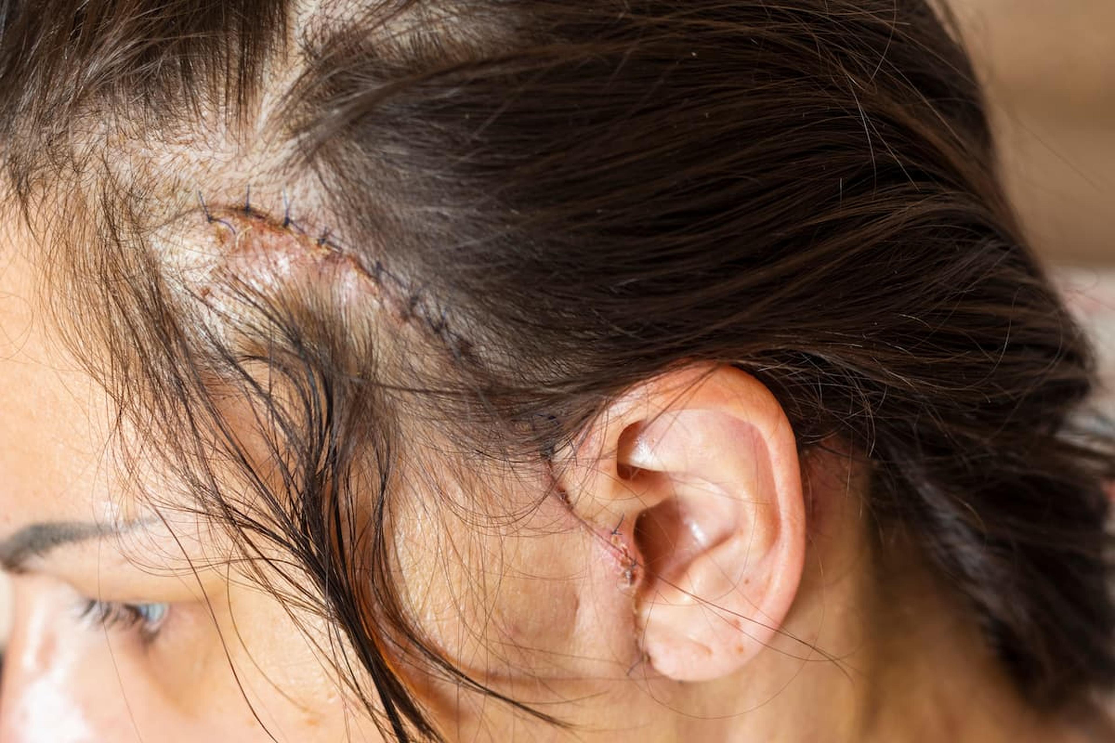 Close-up of a person's head with healing surgical stitches along the hairline near the ear.