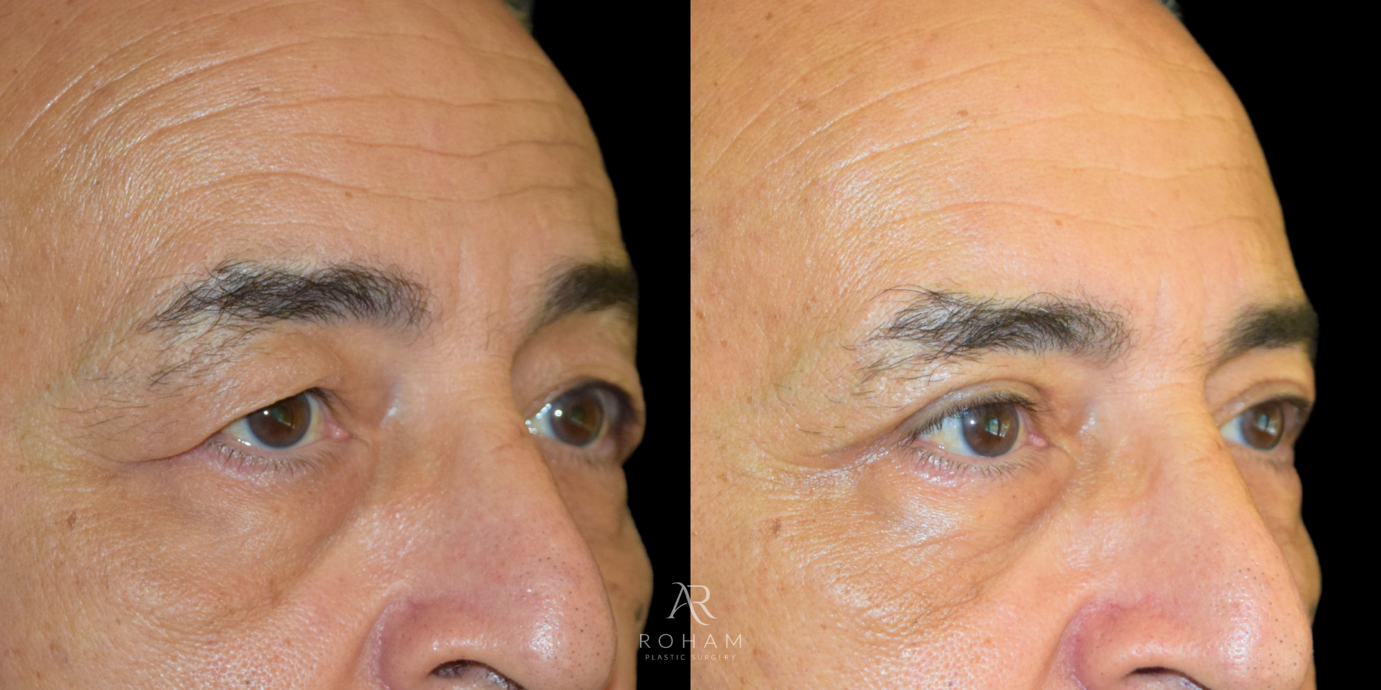 Upper Blepharoplasty  Side view before and after