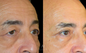 Upper Blepharoplasty  Side view before and after