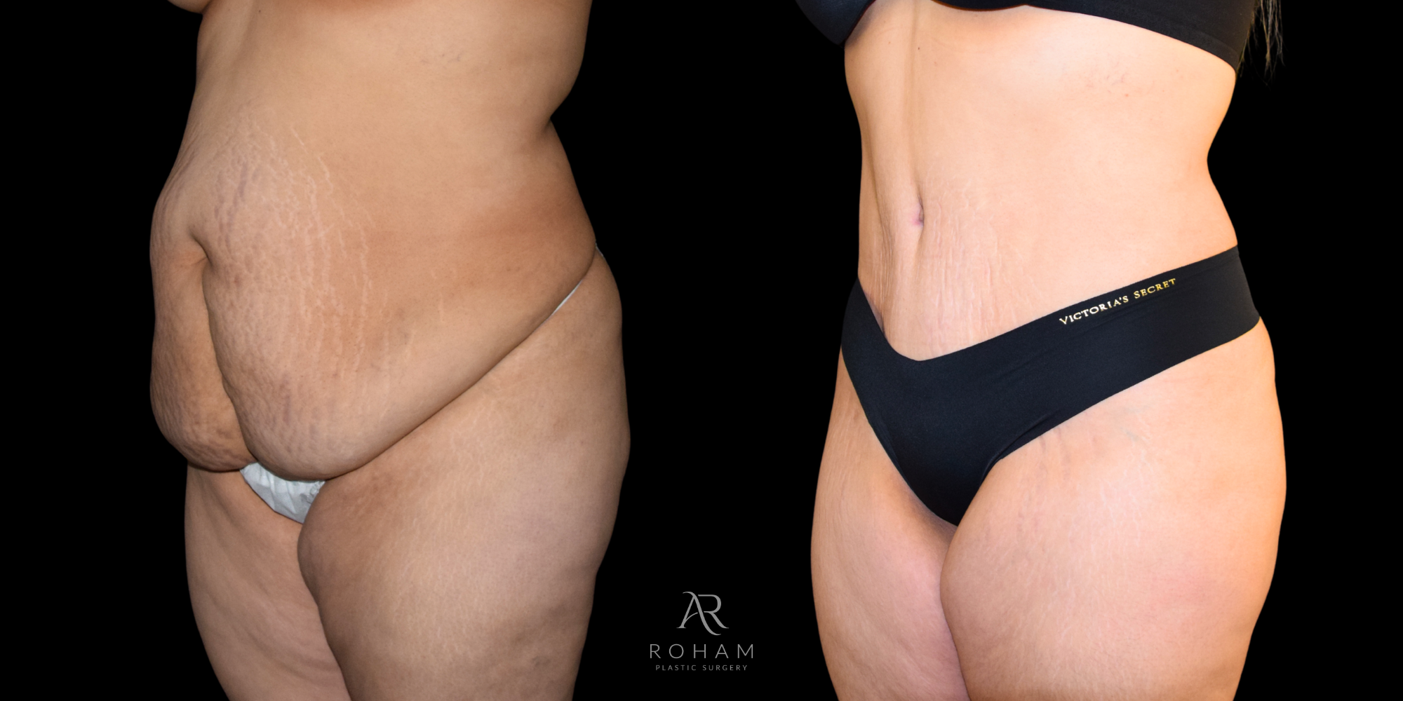 Tummy Tuck Before and after side