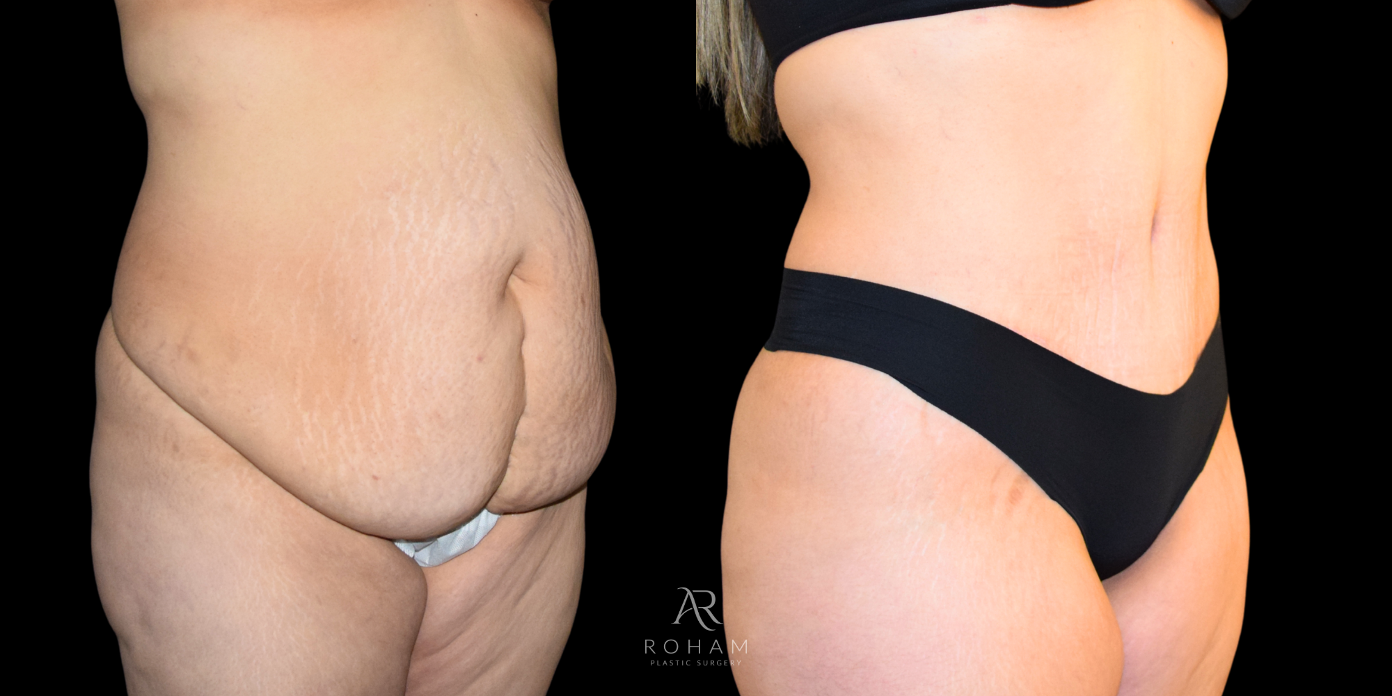 Tummy Tuck Before and after side
