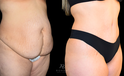 Tummy Tuck Before and after side