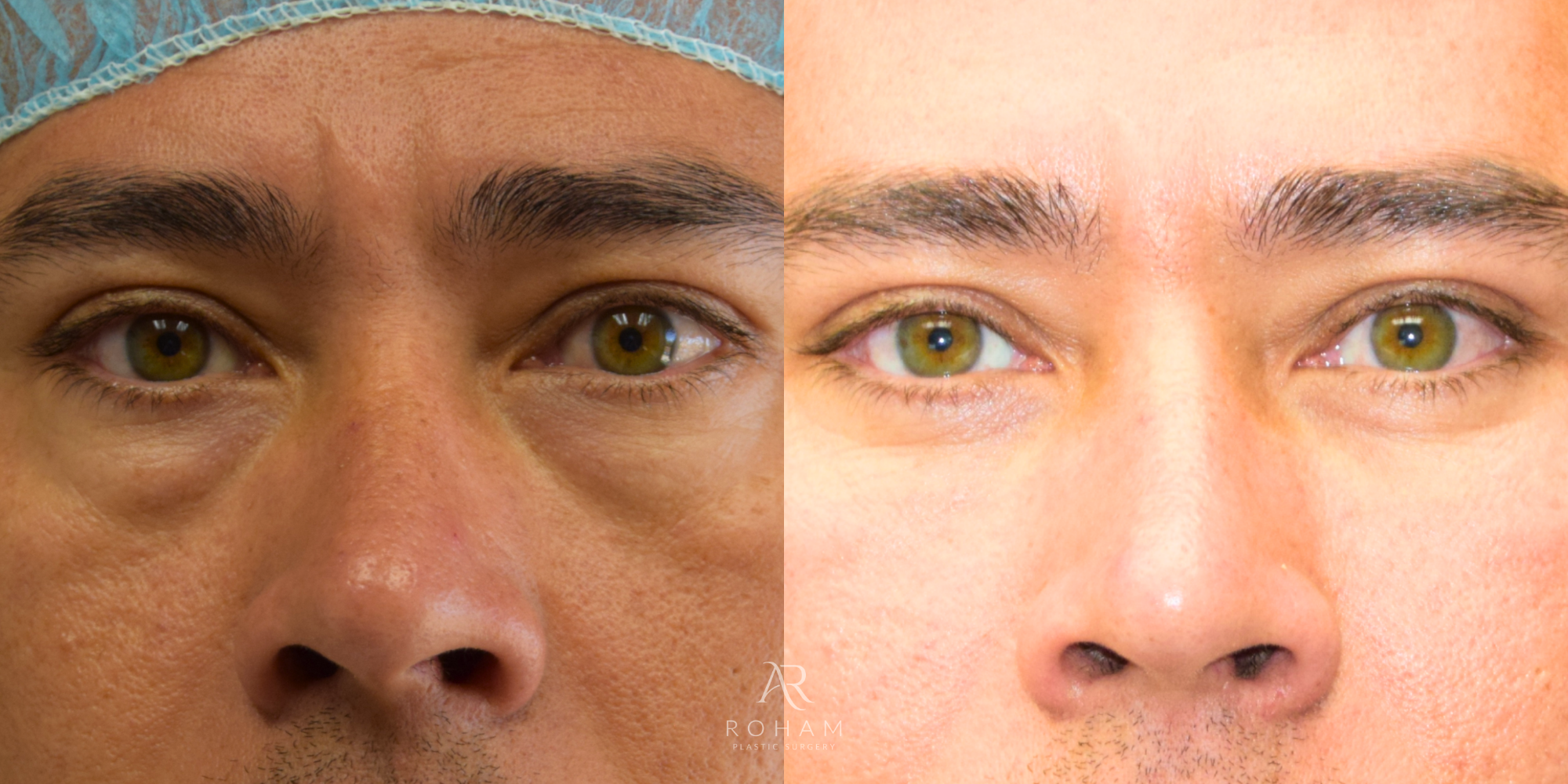 man with green eyes Lower Blepharoplasty with fat grafting before and after