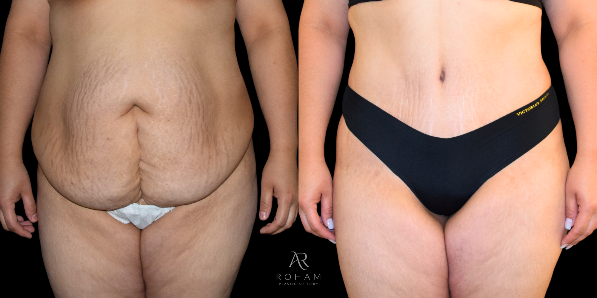 Tummy Tuck Before and after front