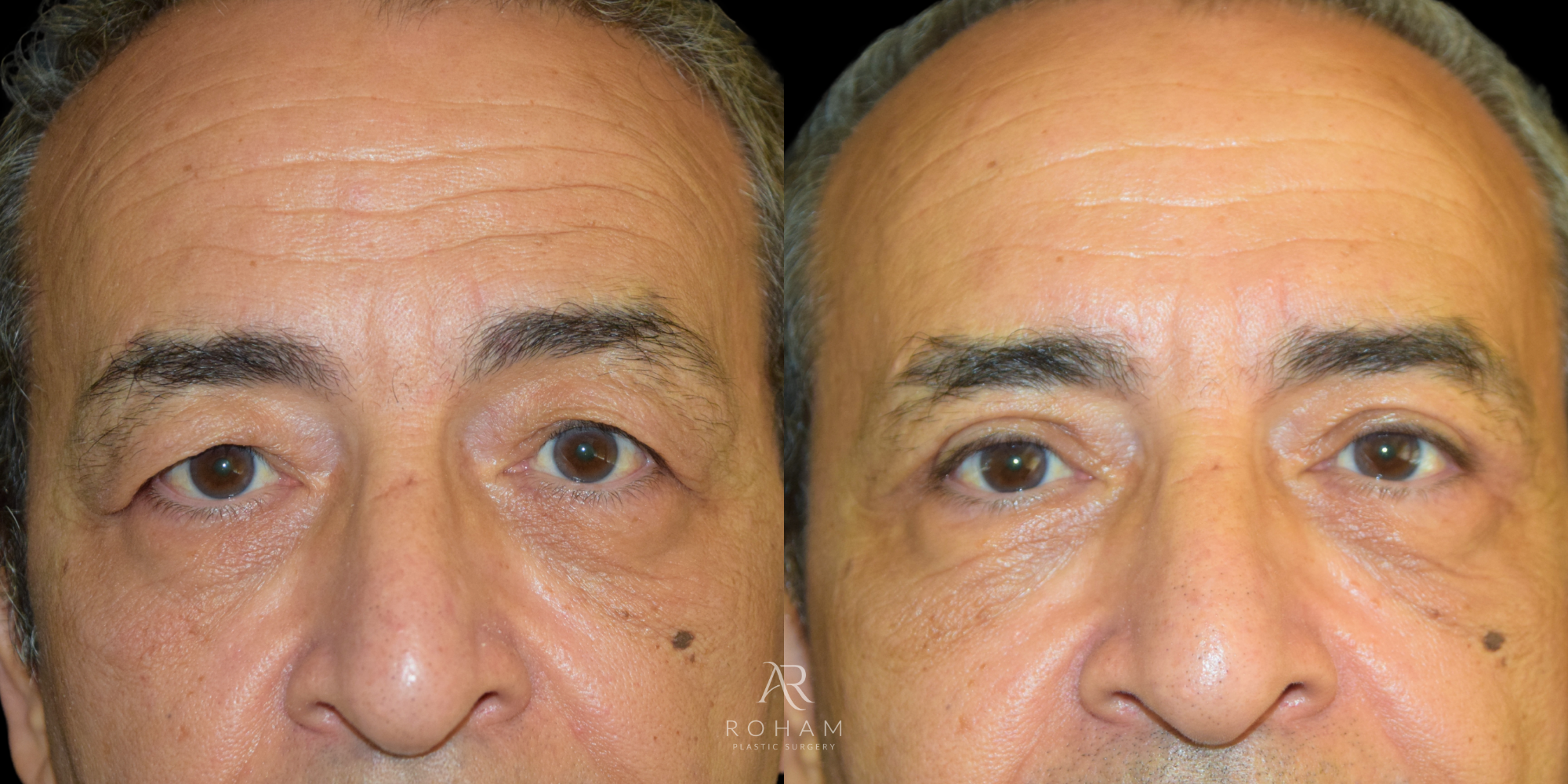 Upper Blepharoplasty  front view before and after