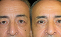 Upper Blepharoplasty  front view before and after