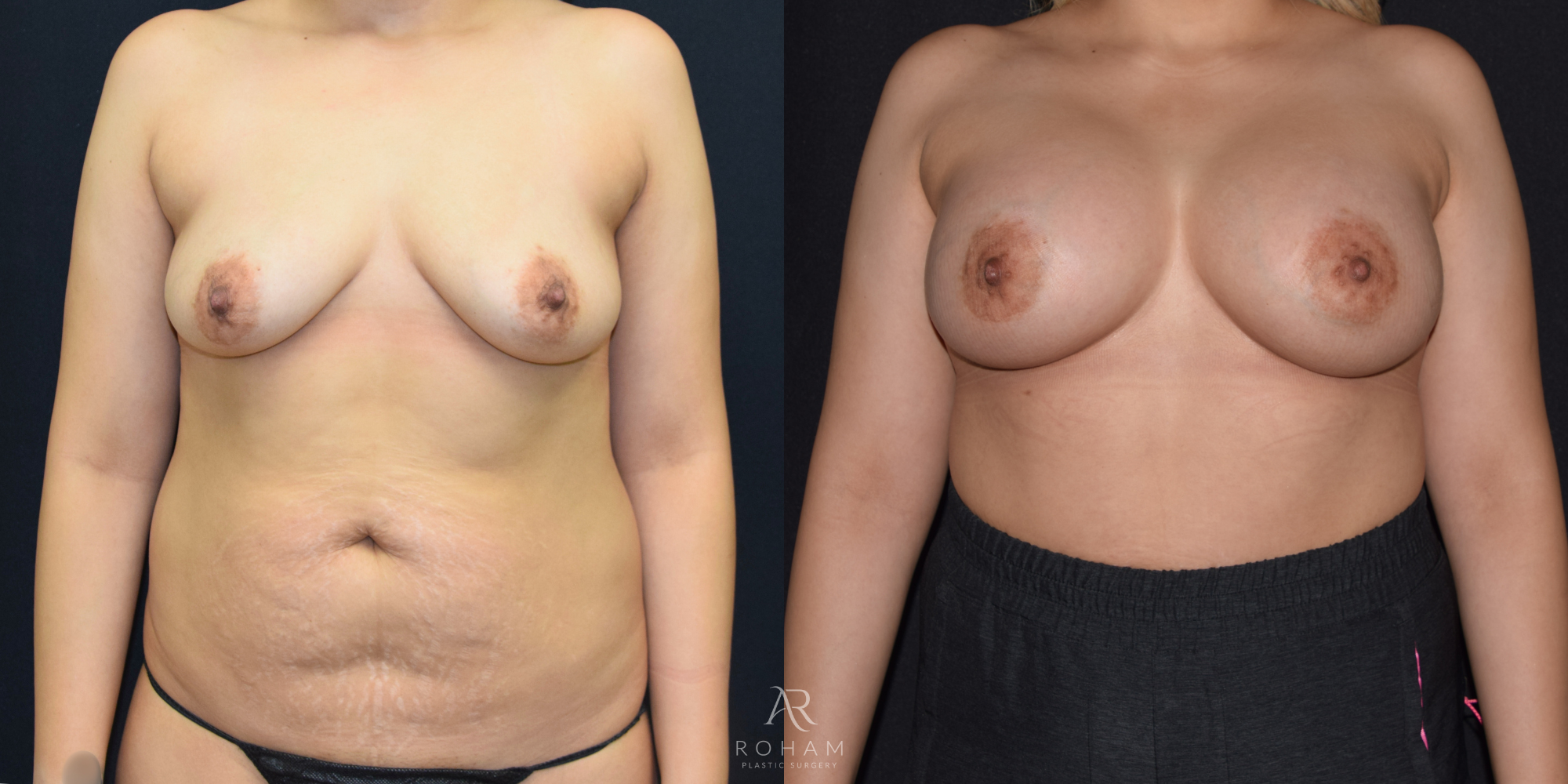Breast Augmentation Results Before and After