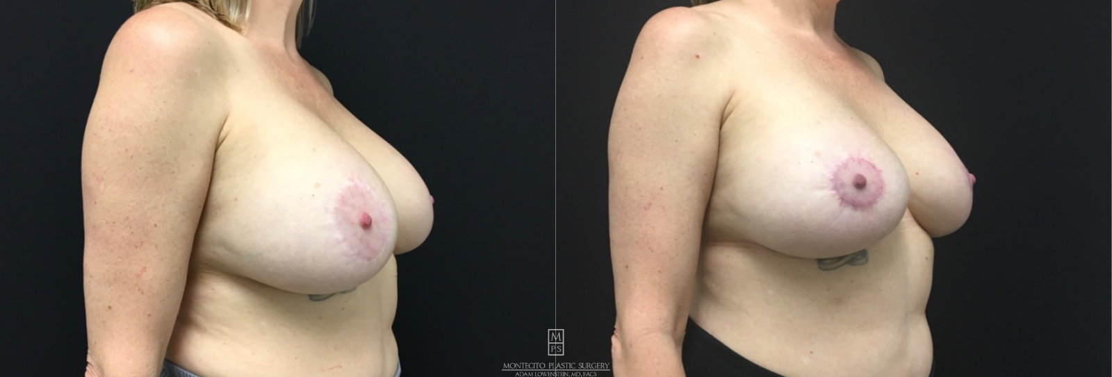 Breast Revision before and after Side