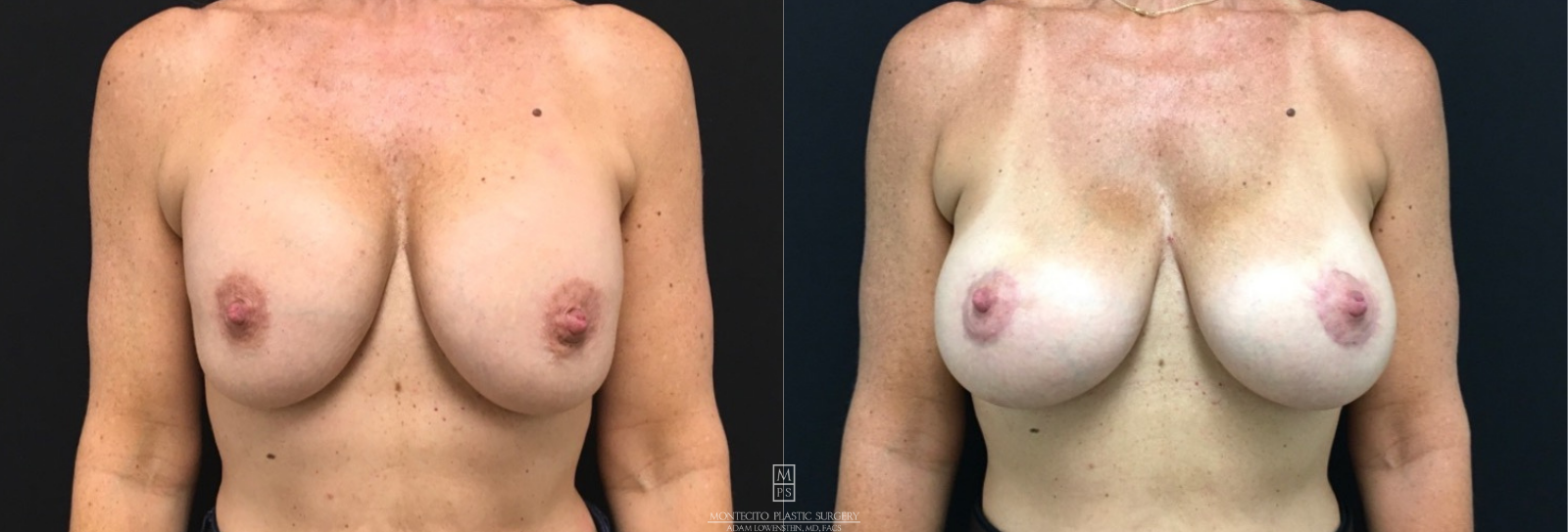 Breast Revision before and after front