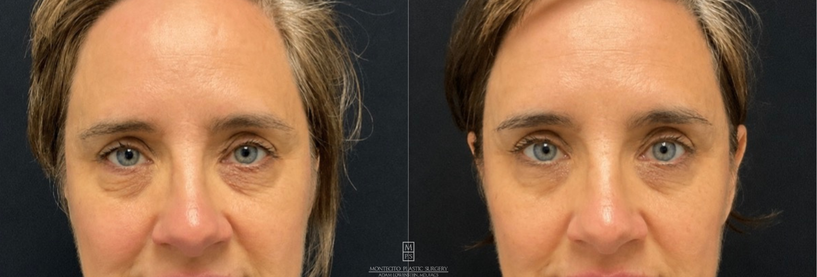 Before and after Cool Peel