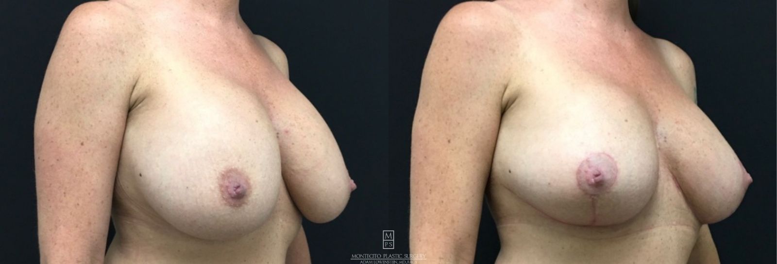 Breast Revision before and after Side