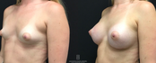 Breast Augmentation Before and After Side