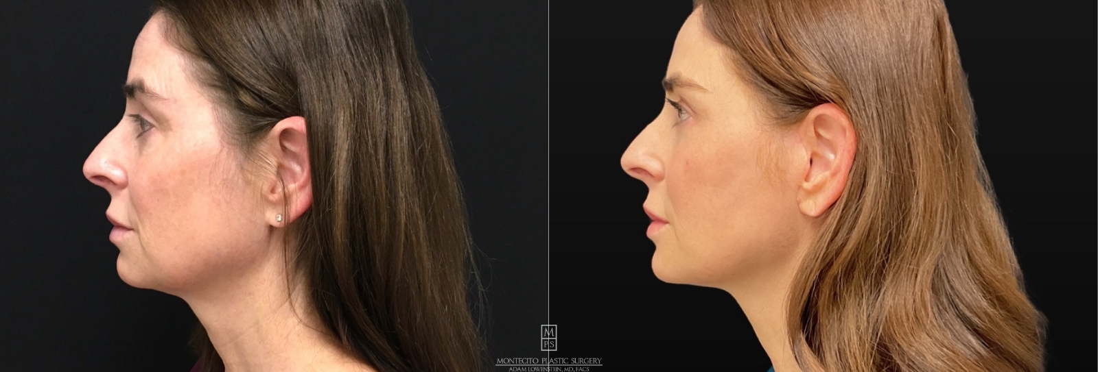 Deep Frame Face Lift Before and After Profile View