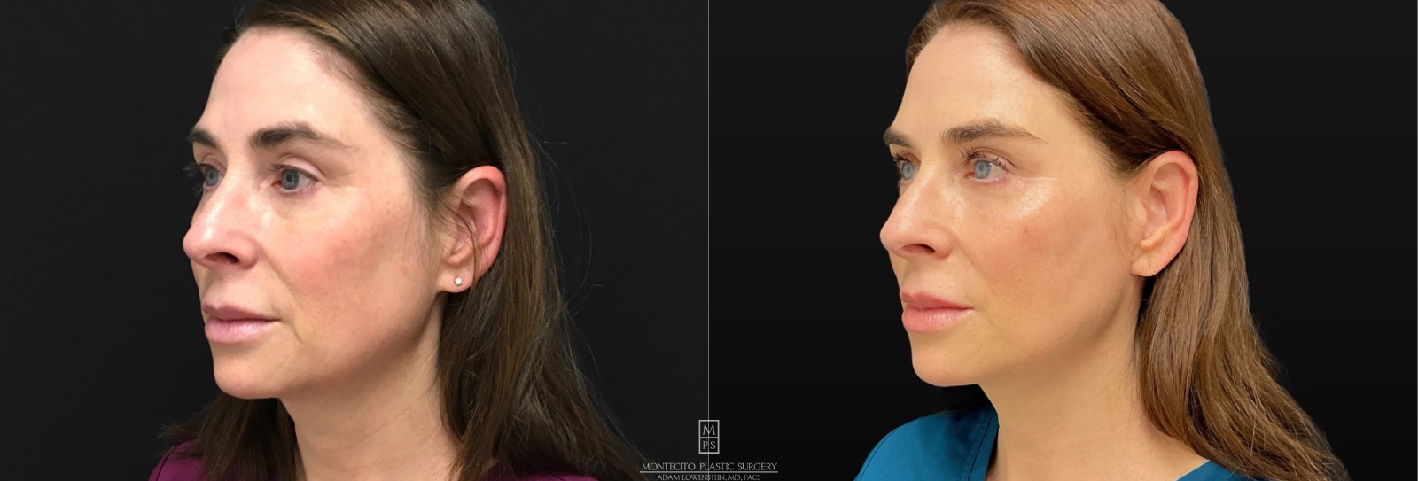 Deep Frame Face Lift Before and After 45 degree