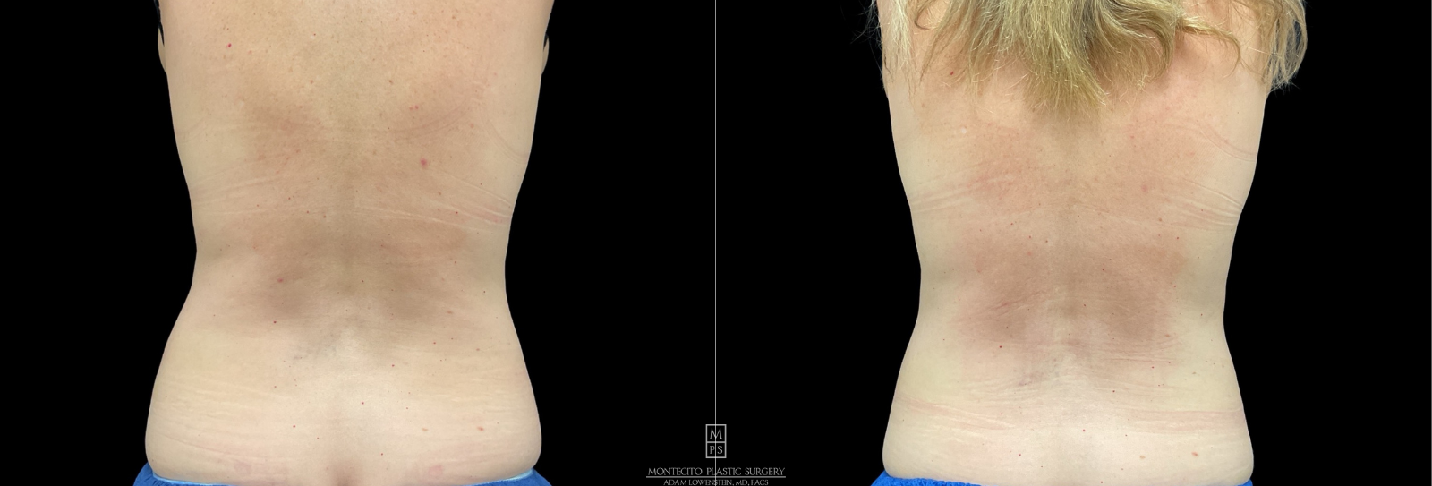 Before and after comparison of a person's back, showing cool sculpting results