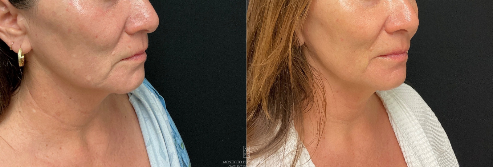 Before and after AVAVA treatment Face