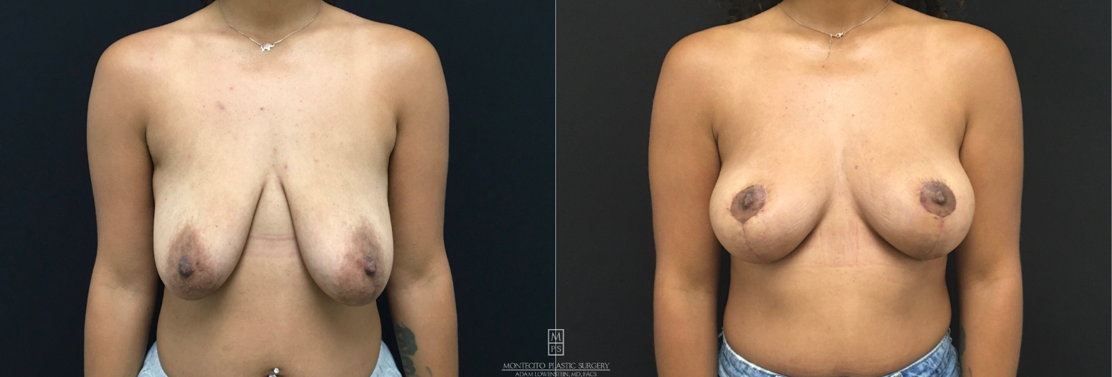 Breast life without Implant front view before and after
