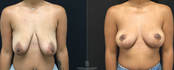 Breast life without Implant front view before and after