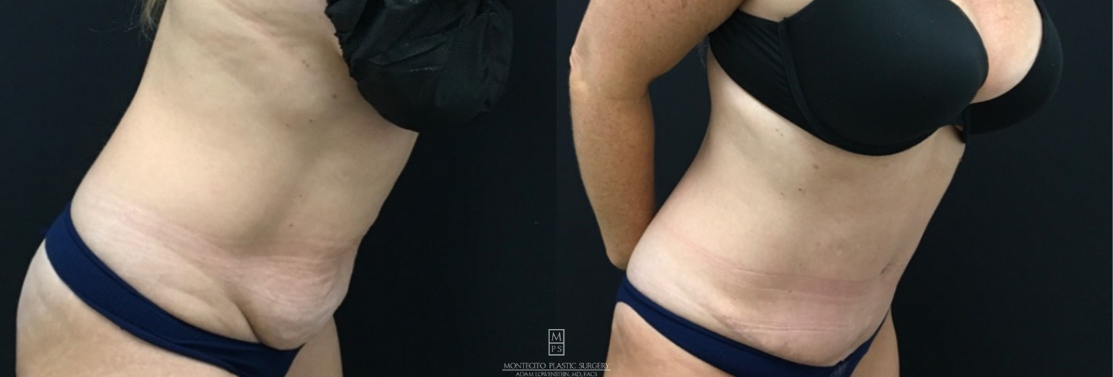 Tummy Tuck abdominoplasty Sideview before and after