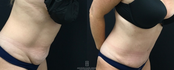 Tummy Tuck abdominoplasty Sideview before and after