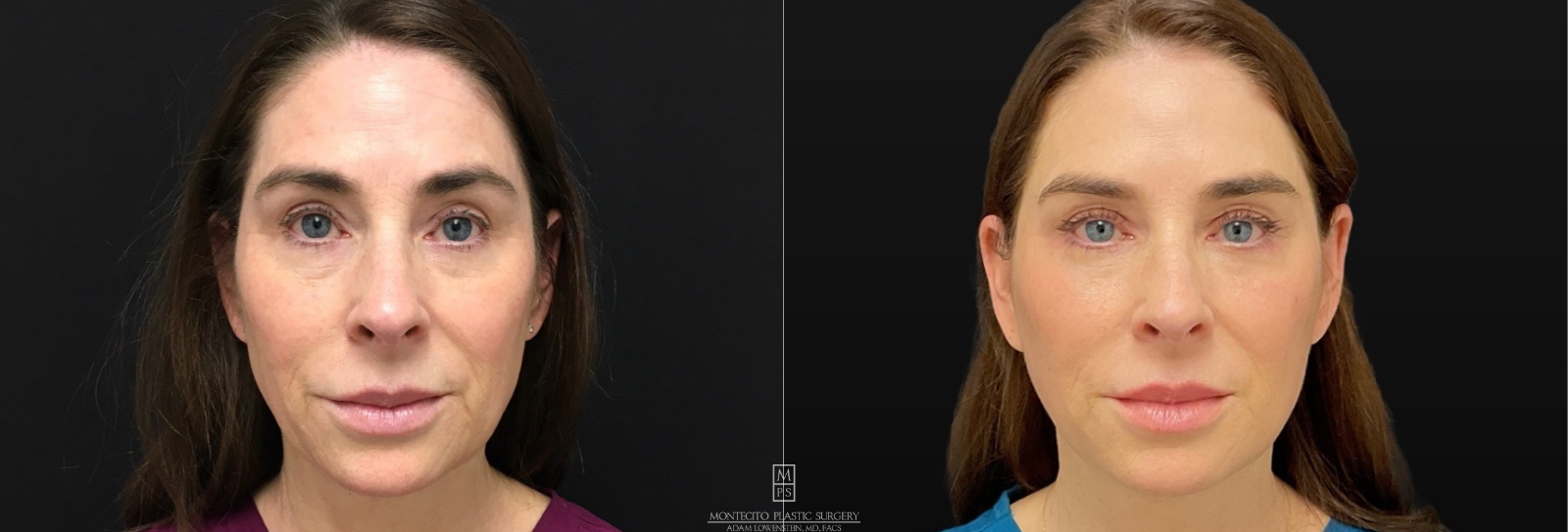 Deep Frame Face Lift Before and After Front View