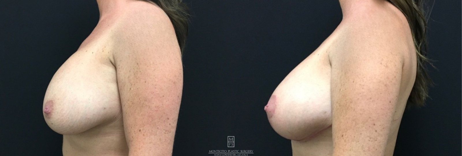 Breast Revision before and after Side