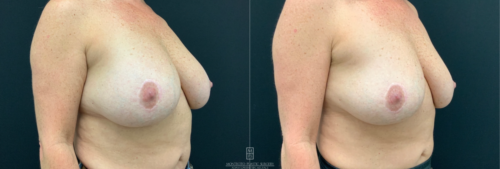 Explant before and after  45 degree side view