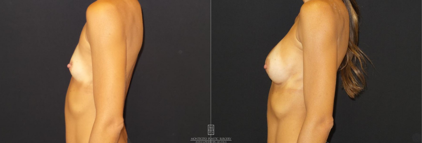 Breast Augmentation  BEFORE AND AFTER LEFT VIEW