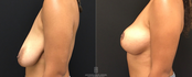 Breast life without Implant Profile view before and after