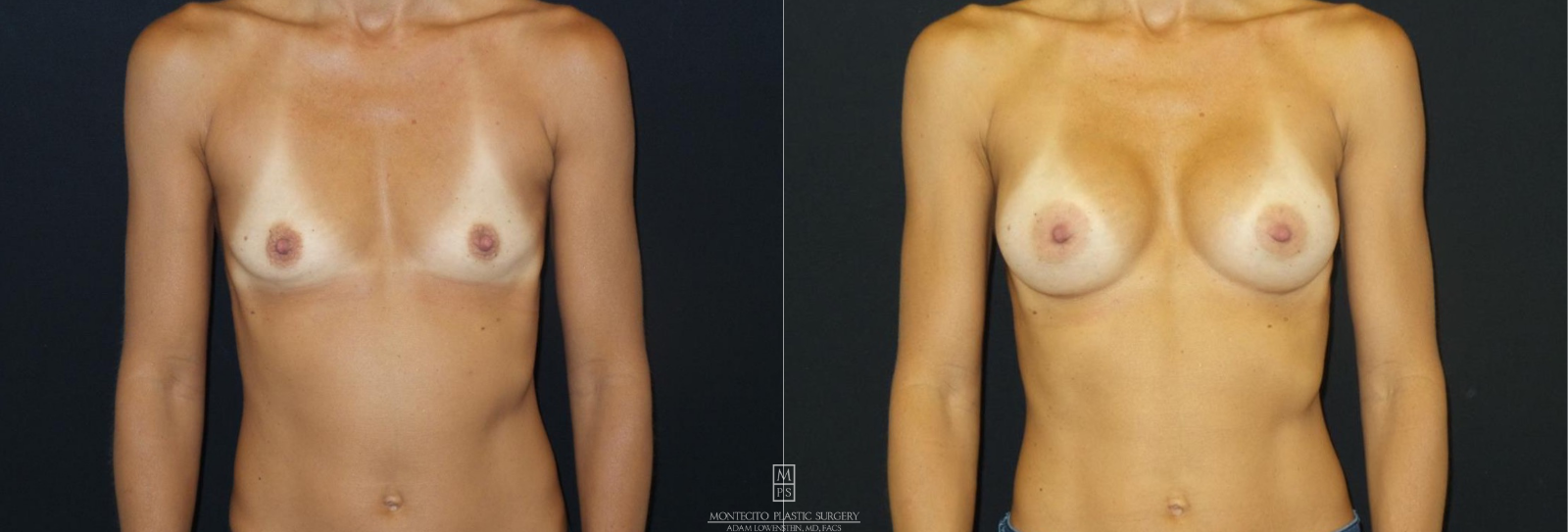 Breast Augmentation BEFORE AND AFTER FRONT VIEW