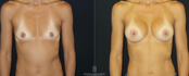 Breast Augmentation BEFORE AND AFTER FRONT VIEW