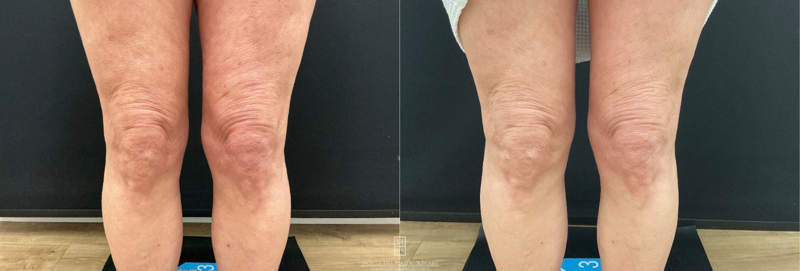 Before and after AVAVA treatment on legs and thighs