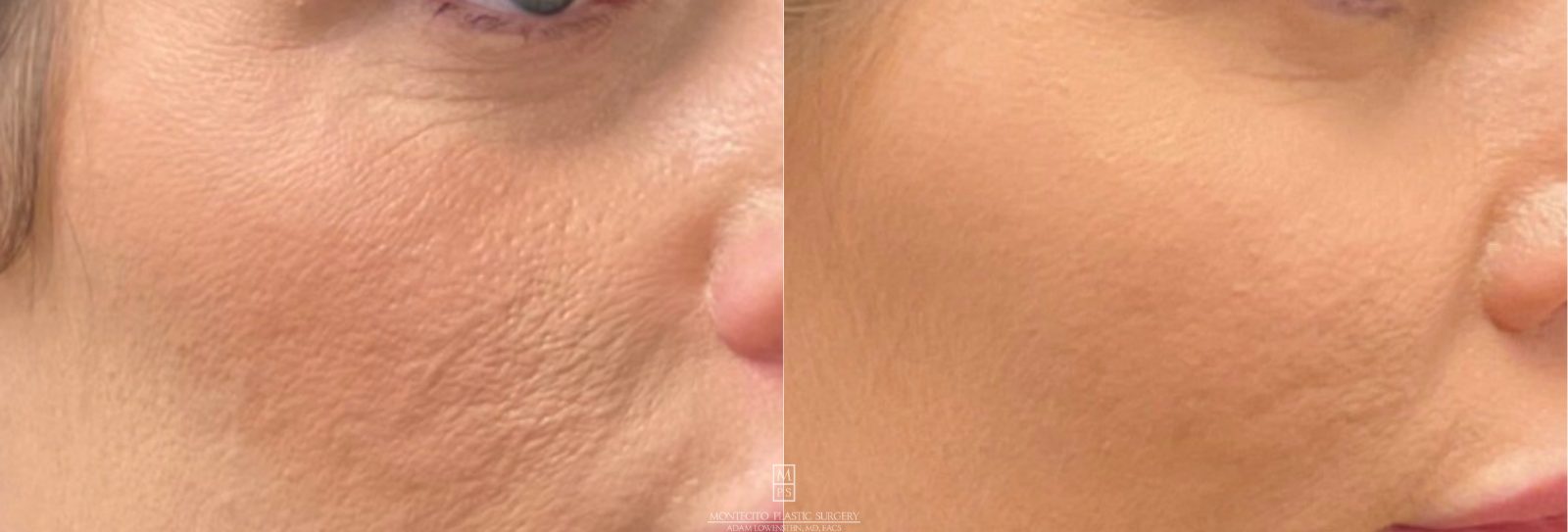 Before and after Cool Peel