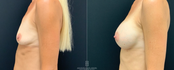 Breast Augmentation Before & After Left View