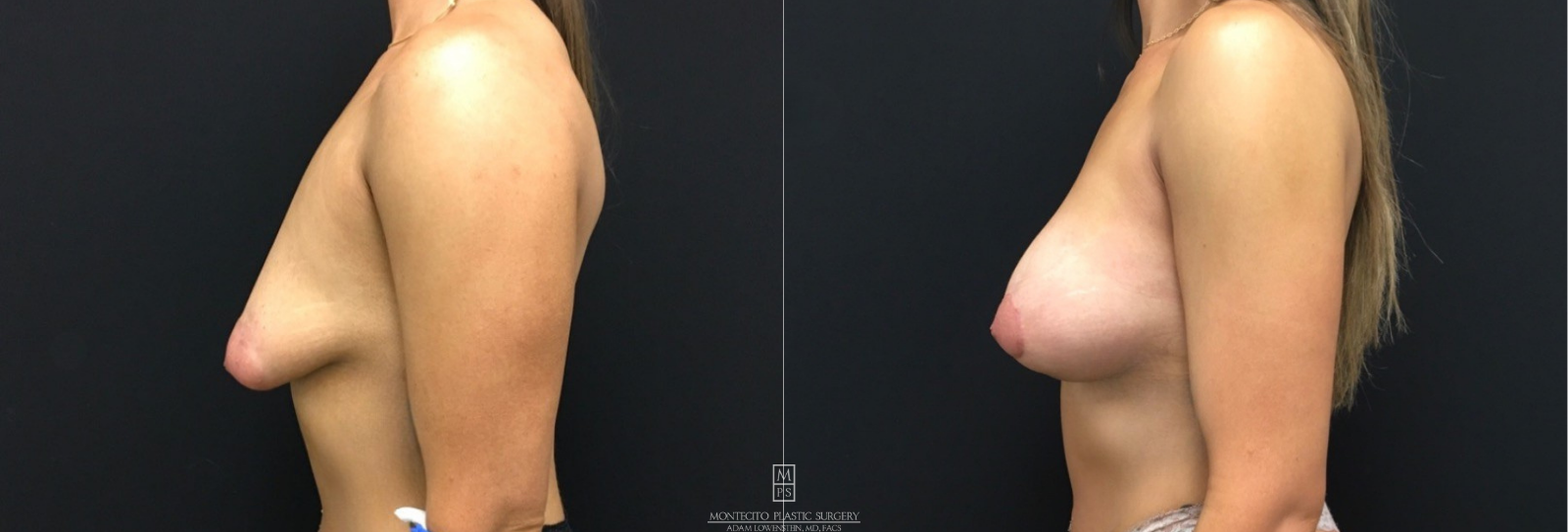 Breast lift Side view before and after