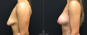 Breast lift Side view before and after