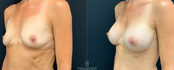 Breast Augmentation Before & After Left 45 View