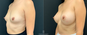 Breast Augmentation Before & After Left 45 view