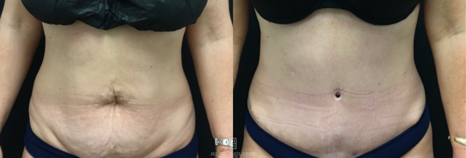 Tummy Tuck abdominoplasty front view before and after
