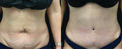 Tummy Tuck abdominoplasty front view before and after
