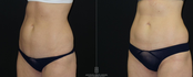 Abdomen before and after cool sculpting