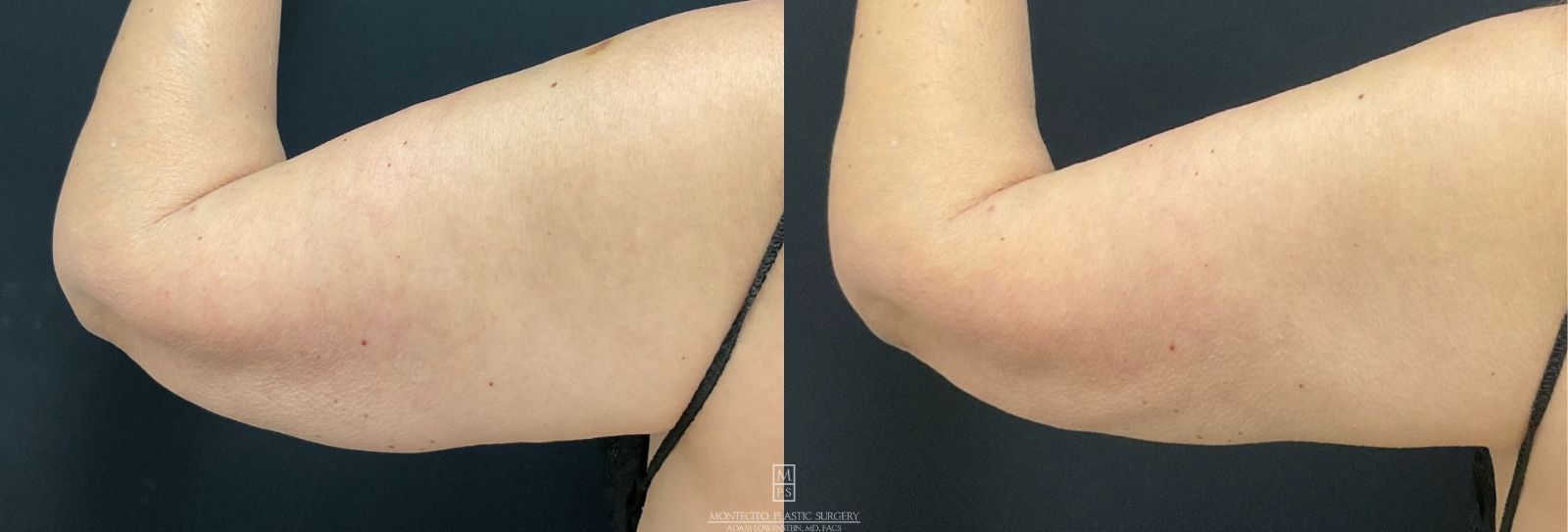 Cool Sculpting Before and after Arm