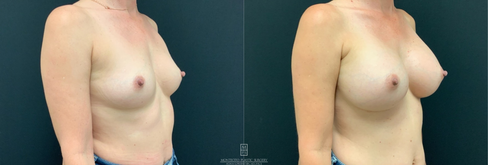 breast augmentation before and after