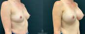 breast augmentation before and after