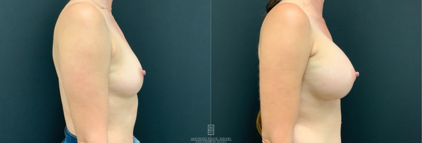 breast augmentation before and after profile view