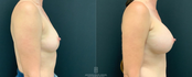 breast augmentation before and after profile view
