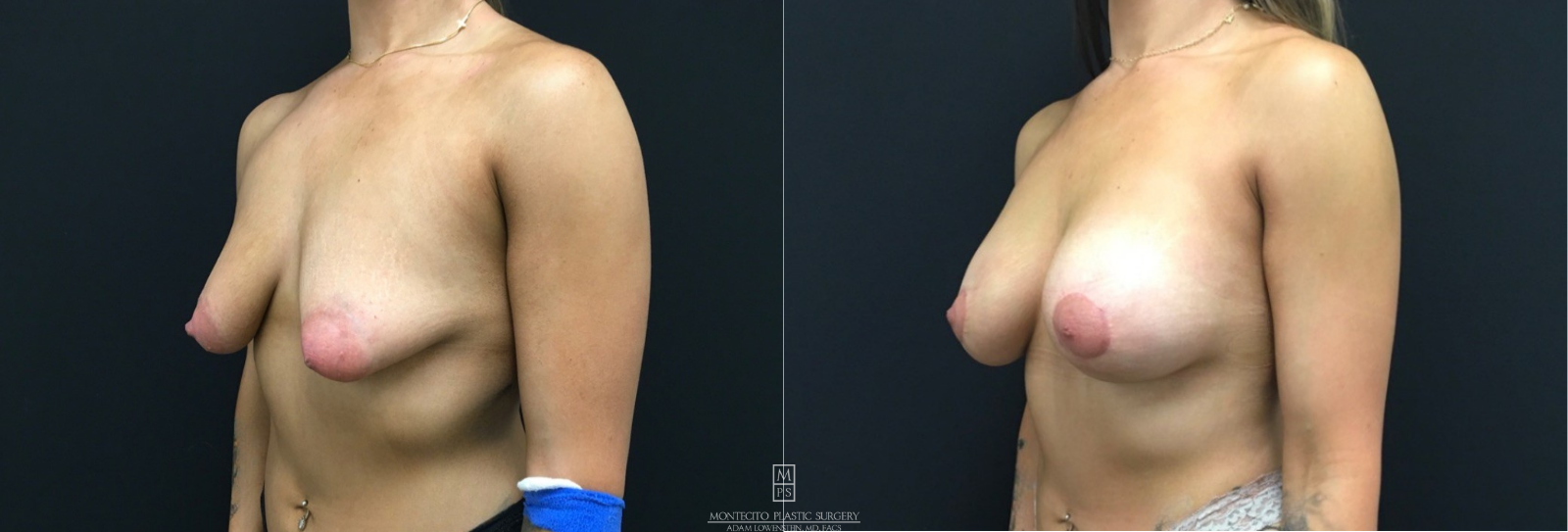 Breast lift Side view before and after