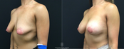 Breast lift Side view before and after