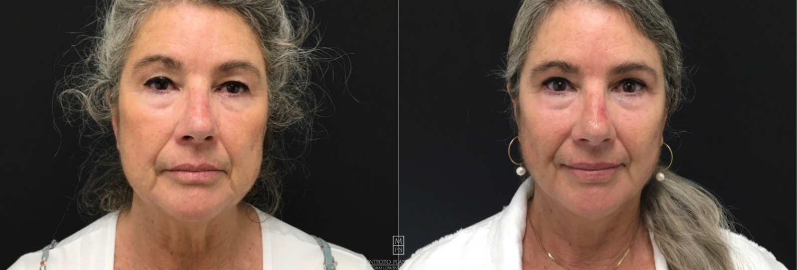 Woman Face Lift Before and After front Profile