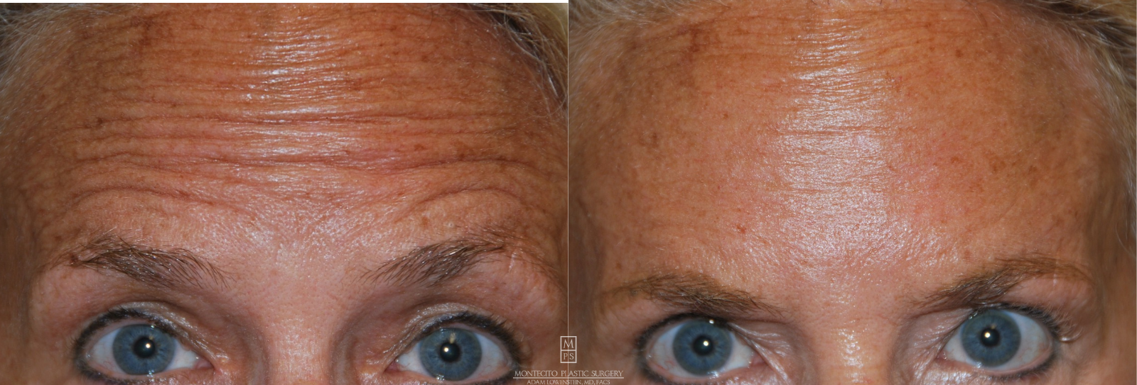 Botox Before and After